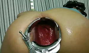 speculum prolapse ka ...